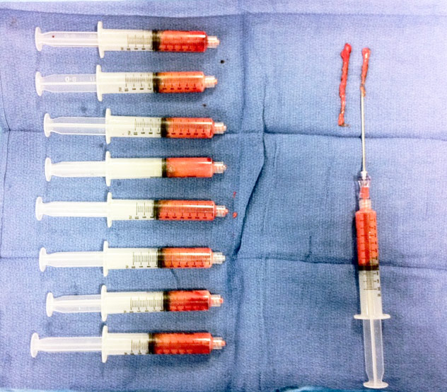 reconstruction mammaire lipofilling